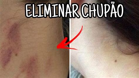 como titar chupao|Como tirar chupão: 8 truques simples para remover。